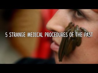 5 Strangest Medical Procedures Of The Past