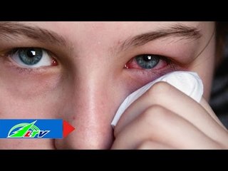 Những điều cần tránh khi đau mắt đỏ | LTV
