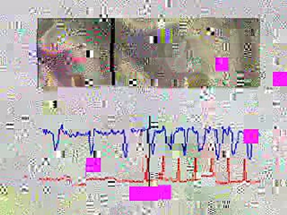 Laser Pacemaker