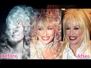 Dolly Parton: Before and After Plastic Surgery