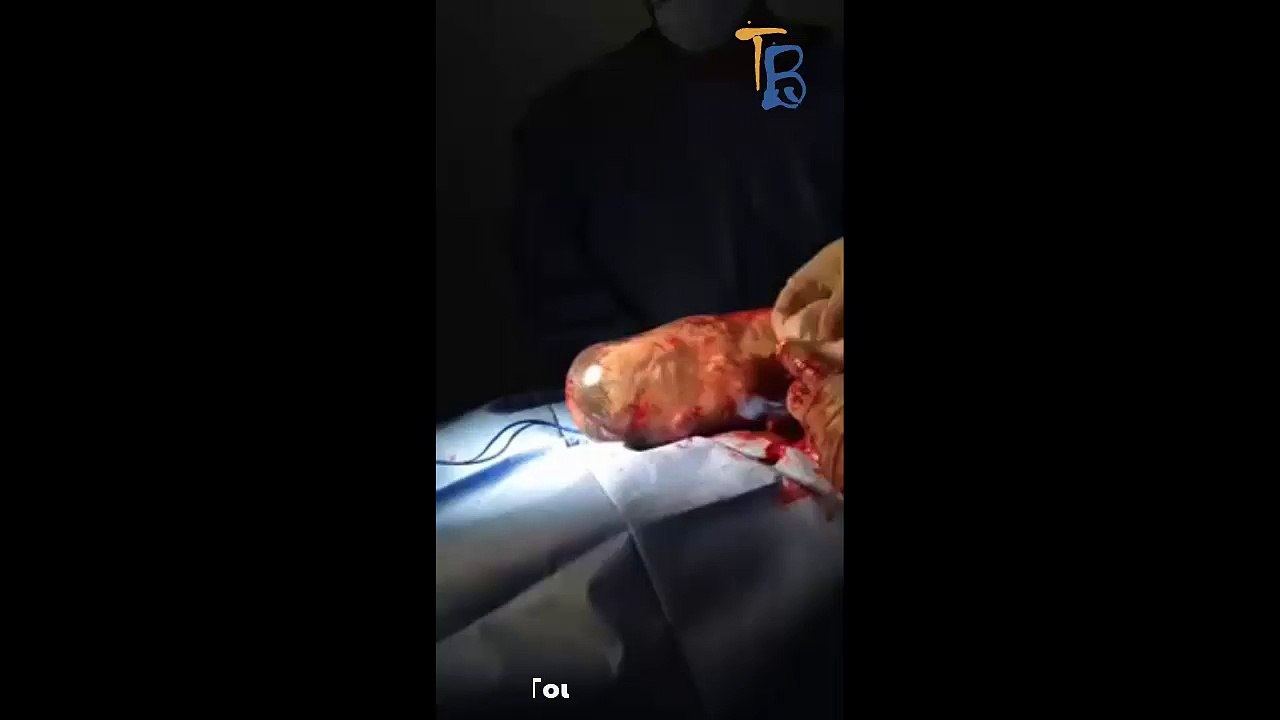 Un bébé vient au monde dans son sac amniotique