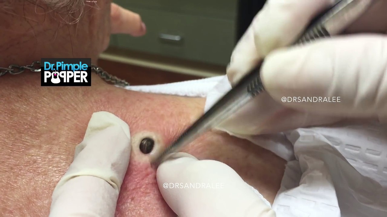 Une mamie de 85 ans a quelque chose d'étrange dans le cou