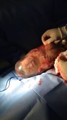 Un bébé est né dans son sac amniotique