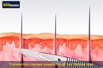 Hair Forever Hair transplant - FUE technique vs FUT technique