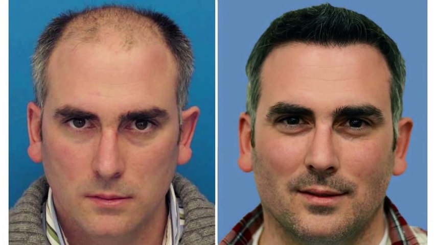 Hair Transplant Mind blowing results - video Dailymotion
