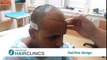 Hair transplantation Advanced FUE Step by Step by Dr. Anastasios Vekris (video)