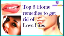 Tips-Top 5 Home remedies to get rid of Love bites