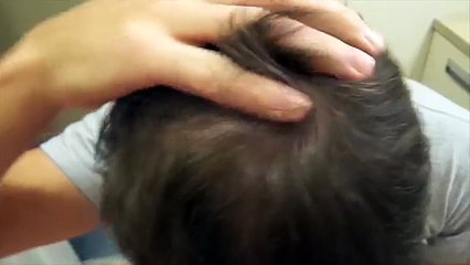 12 months before & after video using Rogaine / Regaine 5% Minoxidil foam & Nizoral 2% Keto