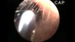 Girls ear infested with giant ants nest horrifies doctors in stomach churning video
