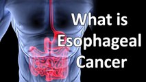 Esophageal Cancer? Types of Esophageal Cancer || Cancer Health