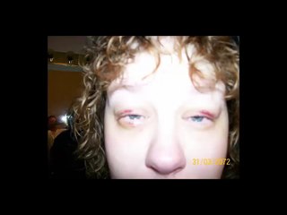 Lasik Complications Lasik Gone Wrong 2016