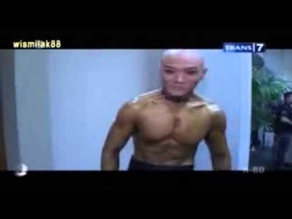 OCD