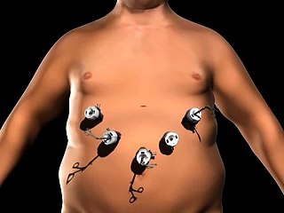 Cirugia de manga Gastrica