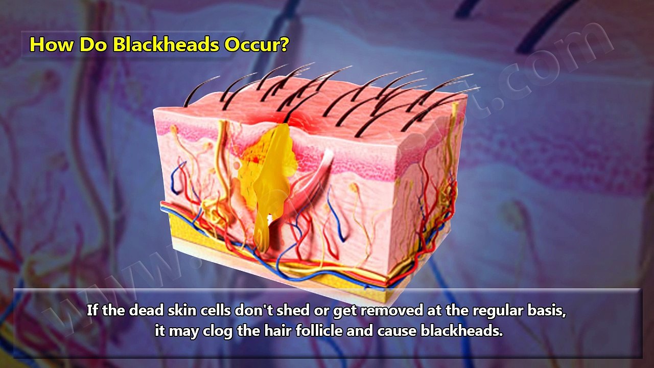 Remove Blackheads Naturally With These Home Remedies