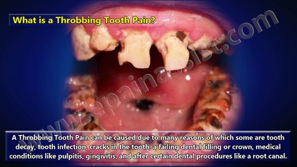 Causes of Throbbing Tooth Pain