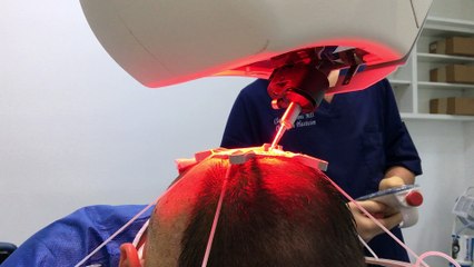 Vue horizontale prélèvemenet de 3000 greffons paris