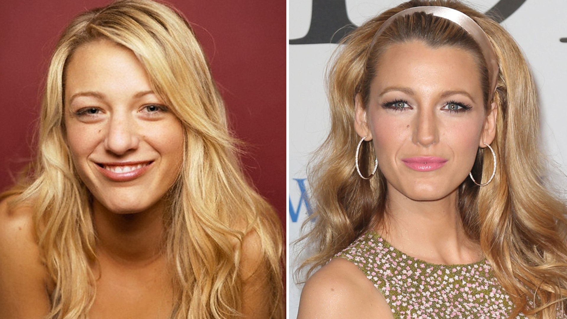 Blake Lively Plastic Surgery