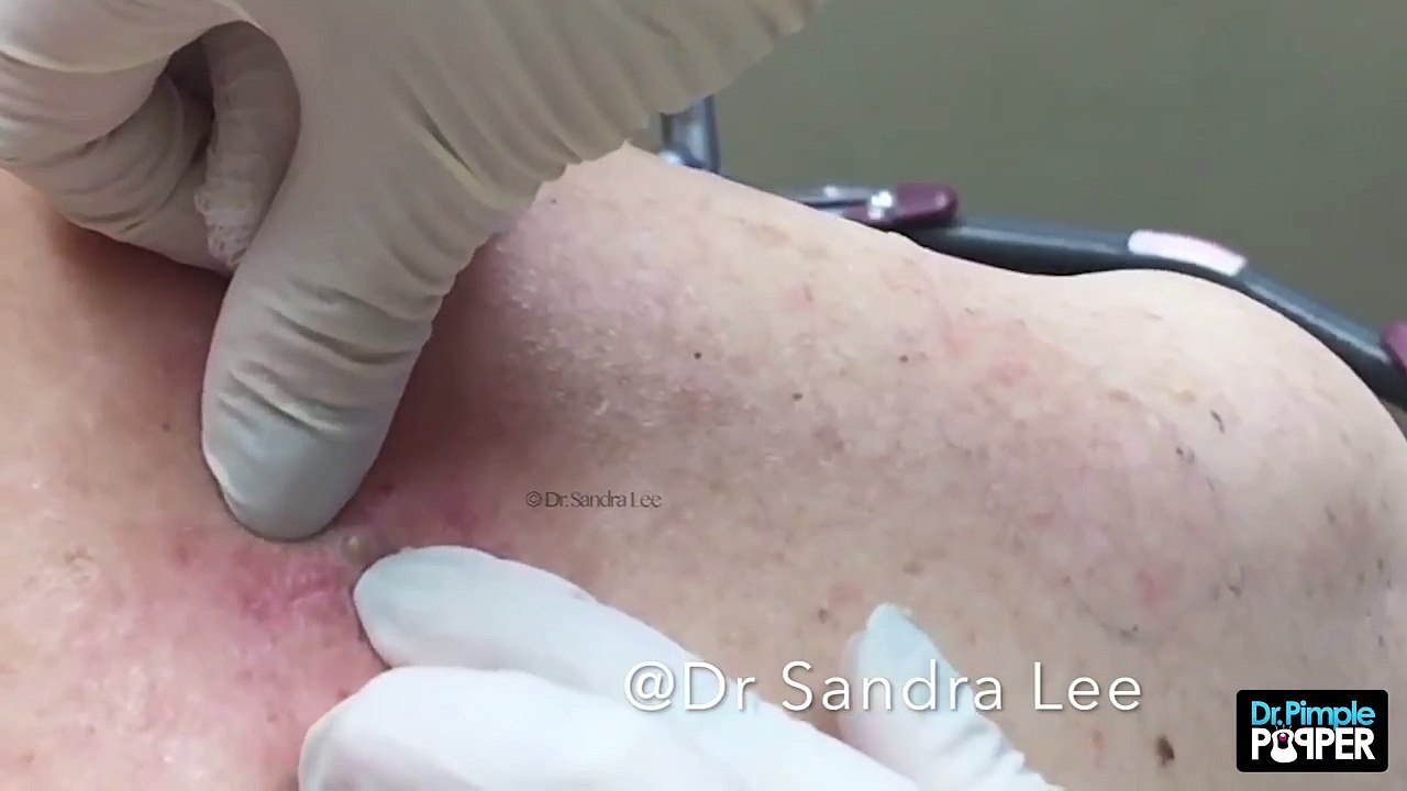 The Return of the Original Big Back Blackheads