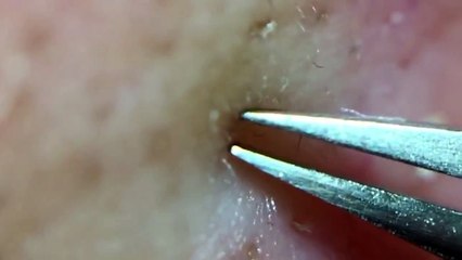 角栓31.2 !!!（Larger version）nose blackheads