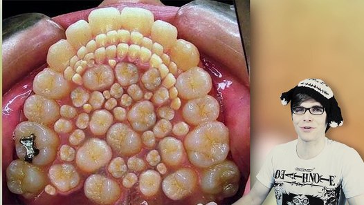 Bad Teeth (Before And After Braces) - Dailymotion Video