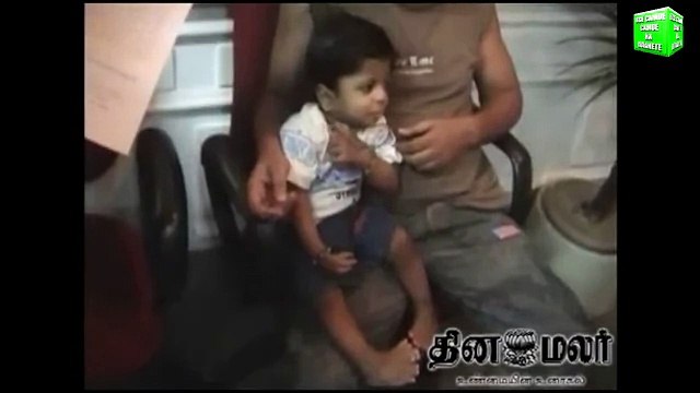 Человек с 34 пальцами — мировой рекорд