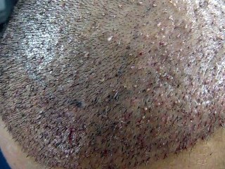 AFTER SURGERY FUE (Hair Transplant)