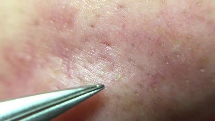 角栓31.1 !!（Farsightedness version）nose blackheads