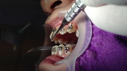 Do Braces Hurt When You First Get Them?