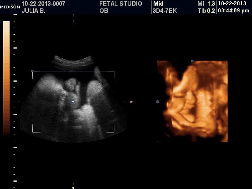 Utah 3d and 4d Prenatal and ultrasound Imaging Center