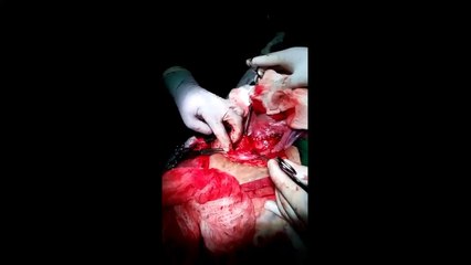 Bladder Stone Removal in Mumbai - Treatment for Bladder India