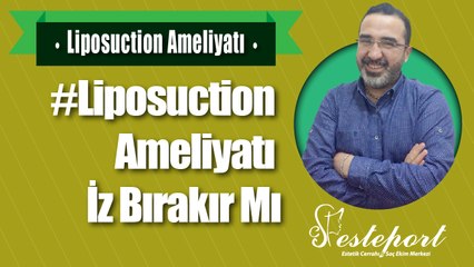 Liposuction Ameliyatı iz Bırakır mı & Esteport