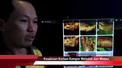 TESTIMONI | BAGAIMANA SAYA MERAWAT KULIT MELECUR AKIBAT KEBAKARAN