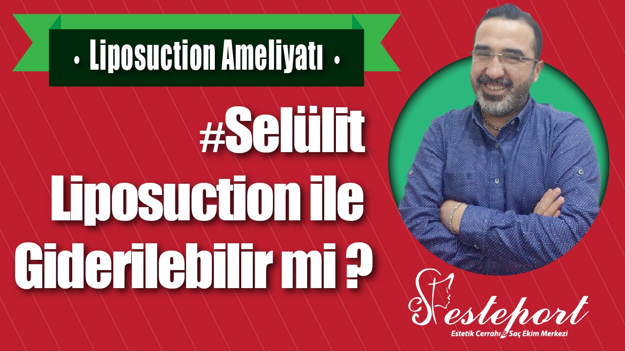 Selülit Liposuction ile Gider mi ?