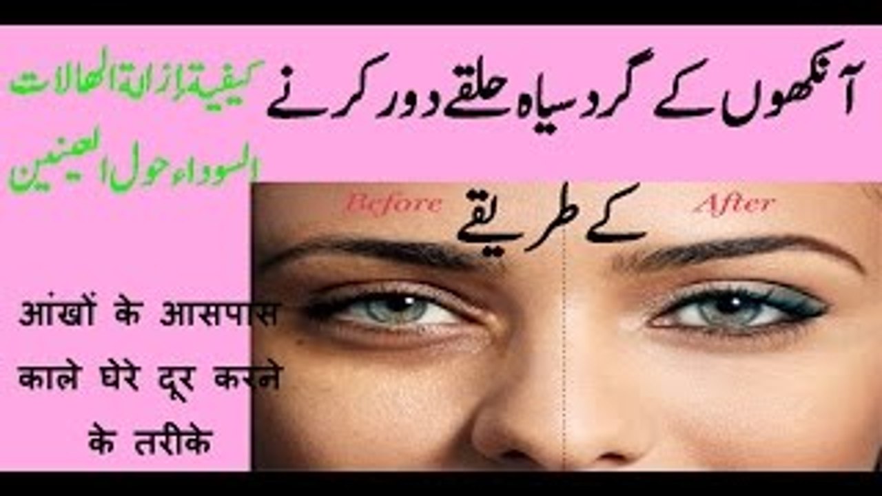 Aankhon Ke Gird Siyah Halke (Dark Circles)