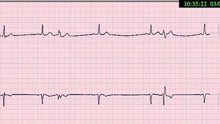 05-EKG-COMPLEXO ATRIAL PREMATURO