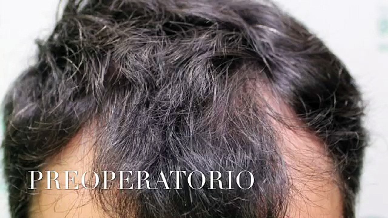 CLINICAS CETA CAPITAL www.injertodepelo.es