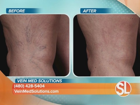 Arizona Vein and Laser Institute explains spider vein treatment options