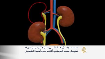 عمليات زراعة الكلى من متبرعين غرباء تطيل العمر