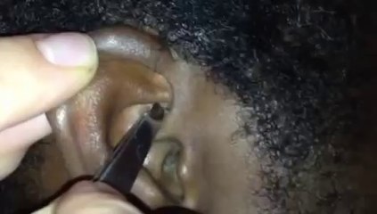 Removing ball of ear wax