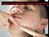 TOP 5 WAYS How To Get Rid Of Acne Scars