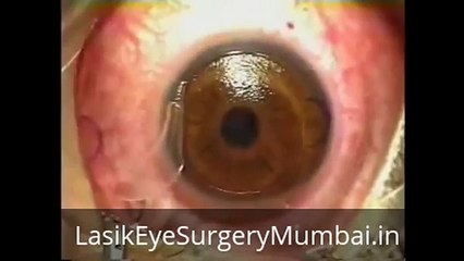 Lasik Eye Surgery Mumbai Video
