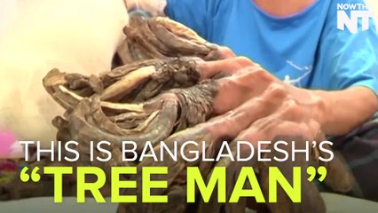 A "Tree Man" Has Lived With Debilitating Bark-like Growths On His Body