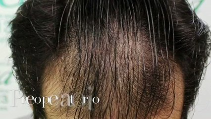 CLINICAS CETA CAPITAL www.injertodepelo.es