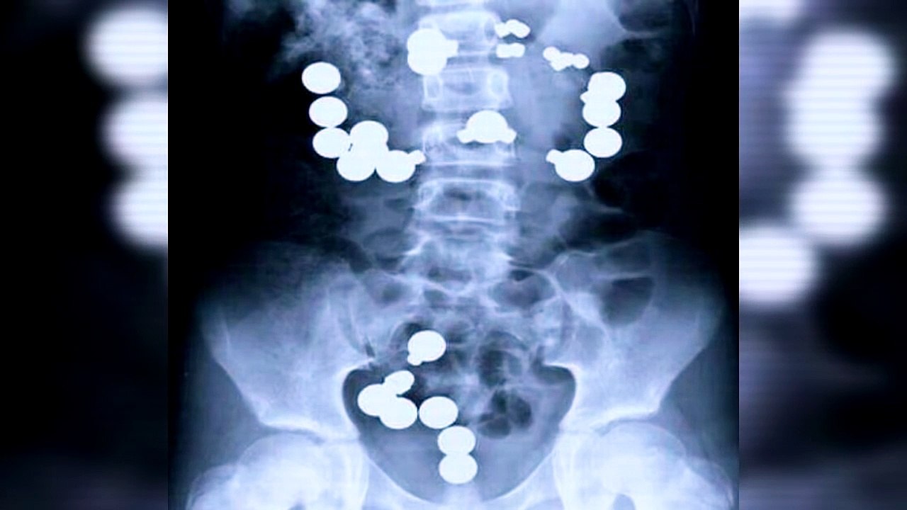 20 Strangest Things Found in Human Bodies (2)