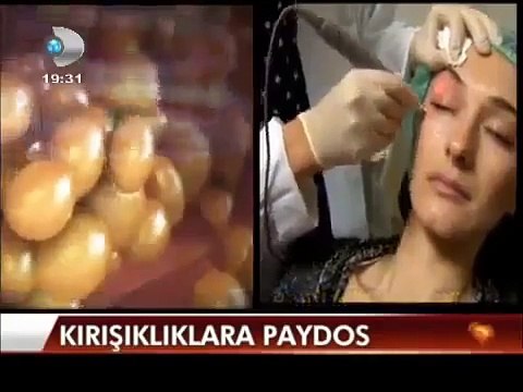 radyo frekans ile cilt gençleştirme ütüleme bakımı yöntemi ile kesin çözüm nasıl uygulanır nedir