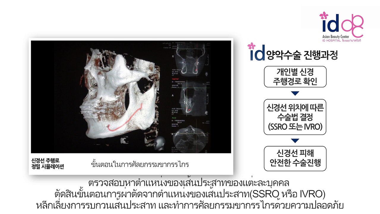 ศัลยกรรมเกาหลี โรงพยาบาลไอดี : POINT! ของการศัลยกรรมขากรรไกรด้วยความปลอดภัย