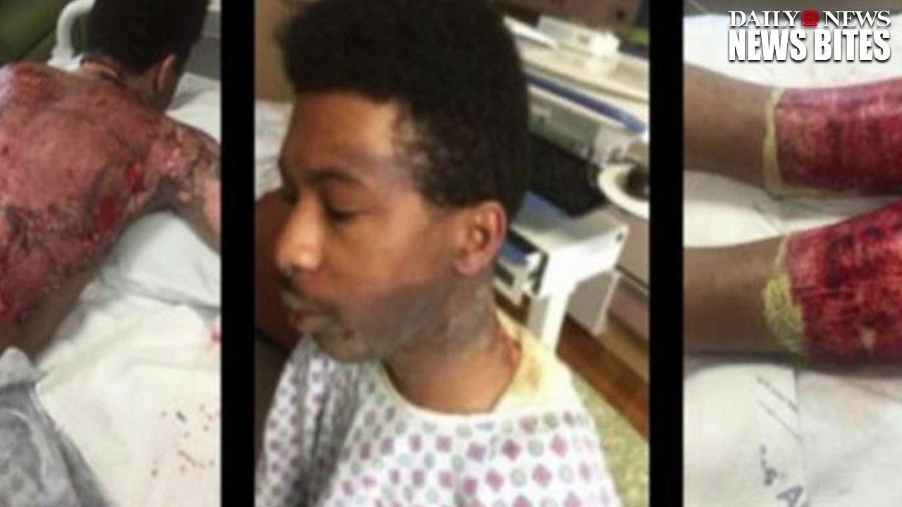 Gay Couple Severely Burned After Mom's Boyfriend Throws Boiling Water on Them