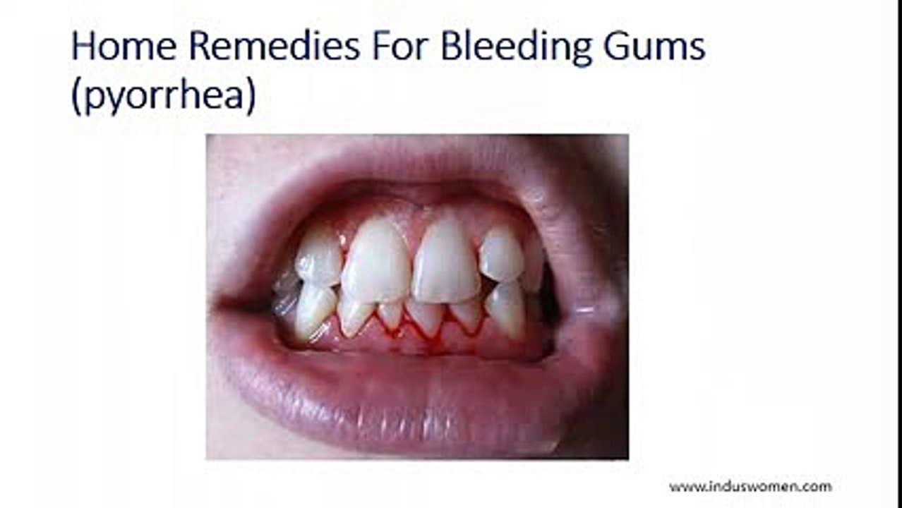 Remedies for Gingivitis - Gum Diseases Remedies