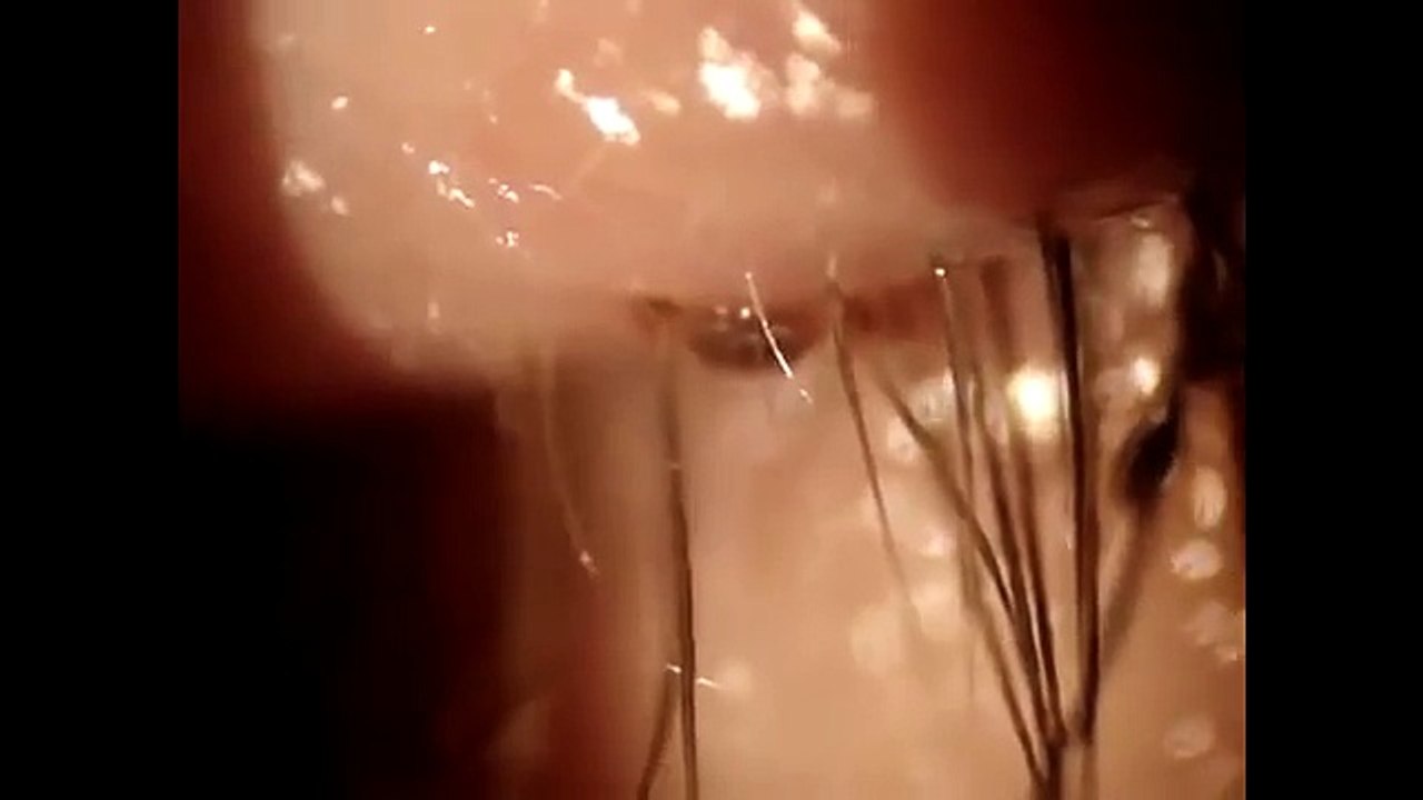When This Lady Finally Went To The Doctor, The Doctor Found Something Shocking In Her Eyelashes.