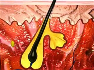 What is acne? Acne formation process